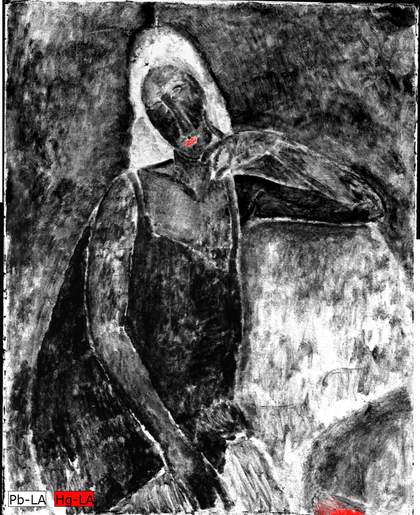 White  areas (indicating lead) are prominent on the hair and the armchair. Red (indicating mercury) is most prominent on the lips