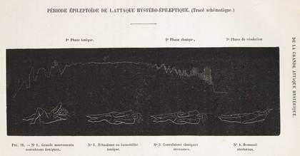 Epileptic phase of an hysterical attack